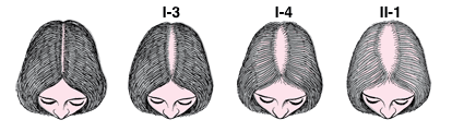ludwig scale female pattern baldness