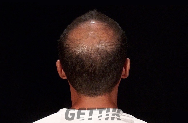 man before using hair thickening fibers
