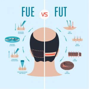 fue vs fut hair transplant